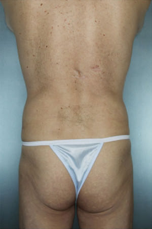 Liposuction Before & After Patient #8704