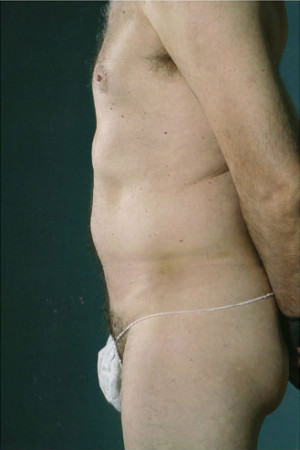 Liposuction Before & After Patient #8704