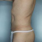 Liposuction Before & After Patient #8704