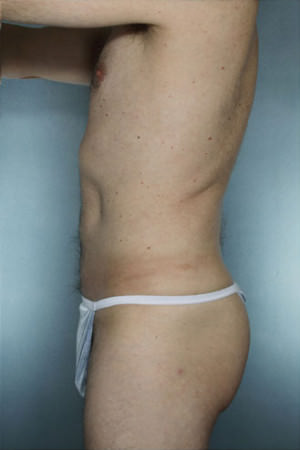 Liposuction Before & After Patient #8704