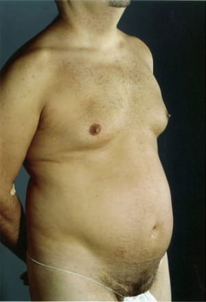 Liposuction Before & After Patient #8711