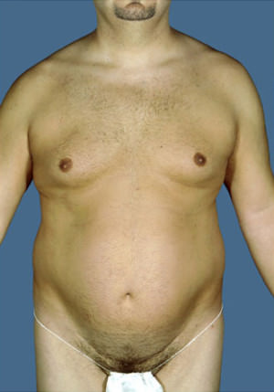 Liposuction Before & After Patient #8711