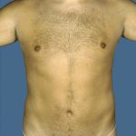 Liposuction Before & After Patient #8711