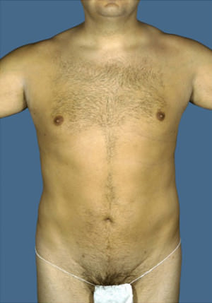 Liposuction Before & After Patient #8711