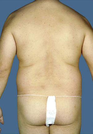 Liposuction Before & After Patient #8711