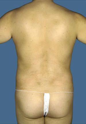 Liposuction Before & After Patient #8711