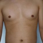 Liposuction Before & After Patient #8718