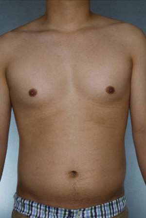 Liposuction Before & After Patient #8718