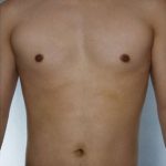 Liposuction Before & After Patient #8718