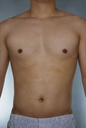 Liposuction Before & After Patient #8718