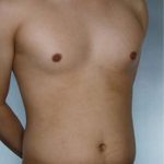 Liposuction Before & After Patient #8718