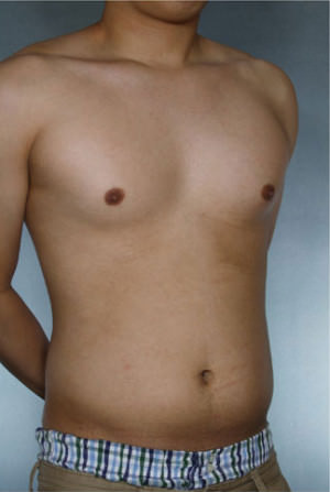 Liposuction Before & After Patient #8718