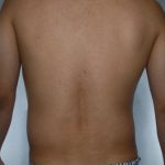 Liposuction Before & After Patient #8718