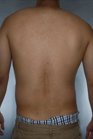 Liposuction Before & After Patient #8718