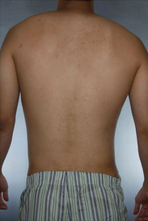 Liposuction Before & After Patient #8718