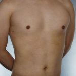 Liposuction Before & After Patient #8718