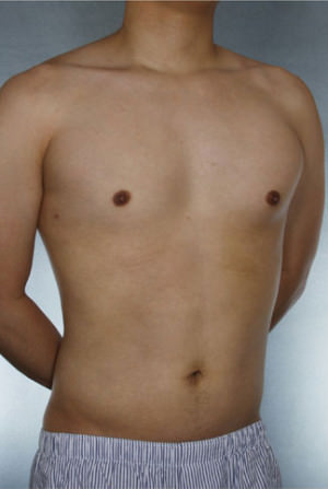 Liposuction Before & After Patient #8718