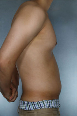 Liposuction Before & After Patient #8718