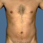 Liposuction Before & After Patient #8727