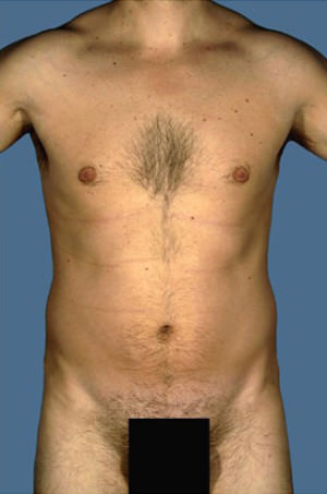 Liposuction Before & After Patient #8727