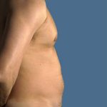 Liposuction Before & After Patient #8727