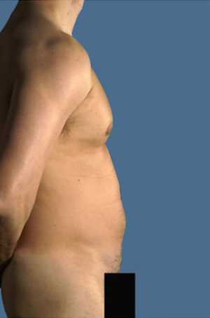 Liposuction Before & After Patient #8727