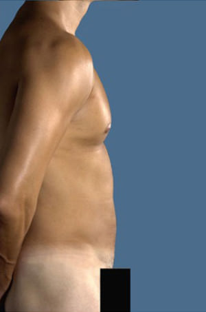 Liposuction Before & After Patient #8727