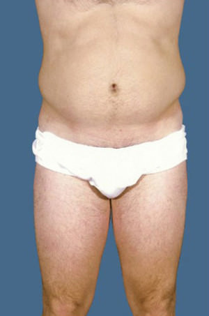 Liposuction Before & After Patient #8732