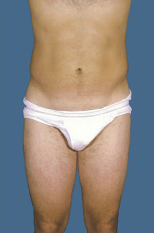 Liposuction Before & After Patient #8732