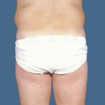 Liposuction Before & After Patient #8732