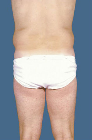 Liposuction Before & After Patient #8732