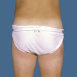 Liposuction Before & After Patient #8732