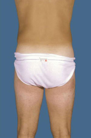 Liposuction Before & After Patient #8732