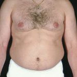 Liposuction Before & After Patient #8737