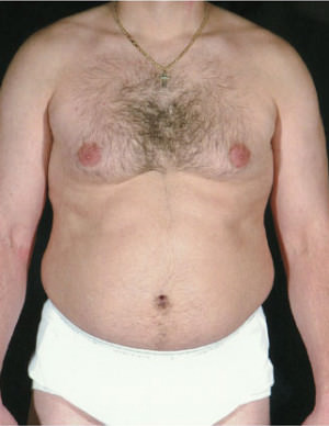 Liposuction Before & After Patient #8737