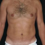 Liposuction Before & After Patient #8737