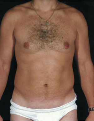 Liposuction Before & After Patient #8737