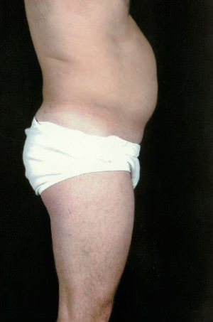 Liposuction Before & After Patient #8737