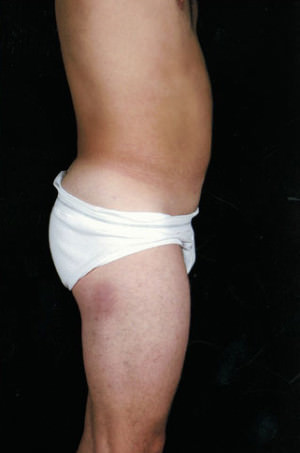 Liposuction Before & After Patient #8737