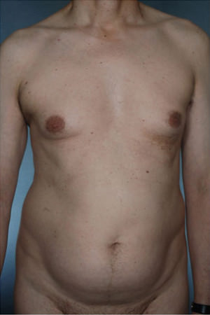 Liposuction Before & After Patient #8742