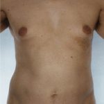Liposuction Before & After Patient #8742