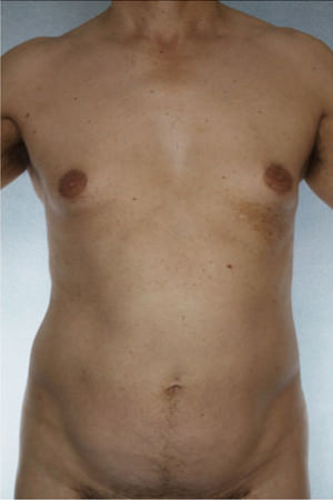 Liposuction Before & After Patient #8742