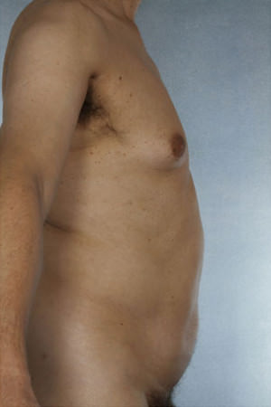 Liposuction Before & After Patient #8742