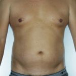 Liposuction Before & After Patient #8747