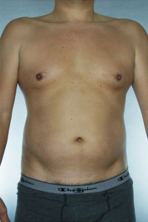 Liposuction Before & After Patient #8747