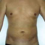 Liposuction Before & After Patient #8747