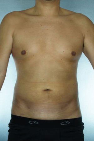 Liposuction Before & After Patient #8747