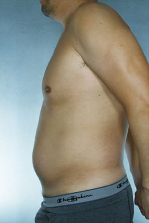 Liposuction Before & After Patient #8747