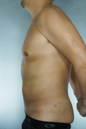 Liposuction Before & After Patient #8747