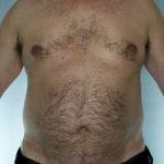 Liposuction Before & After Patient #8752